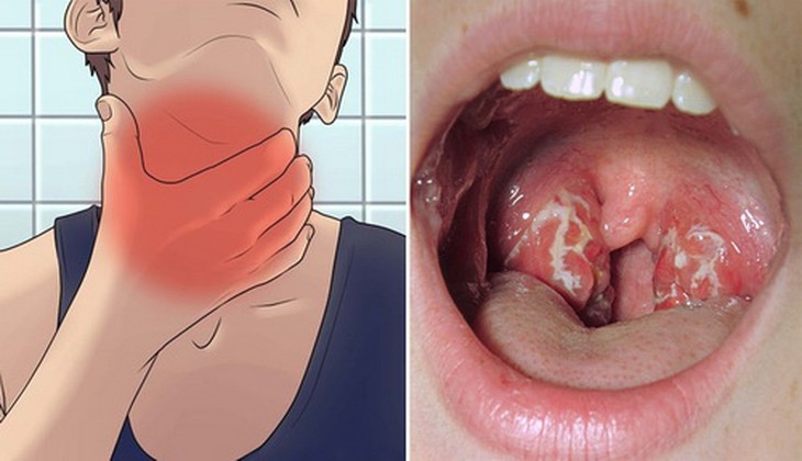Thể hay gặp nhất là bạch hầu họng, mũi.