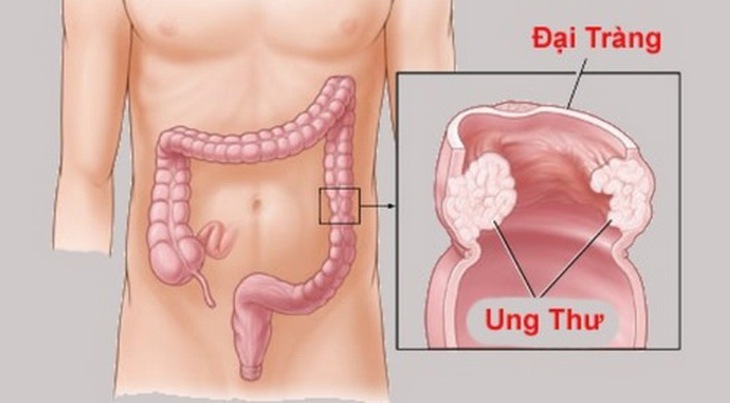 Khi có dấu hiệu đau quặn bụng, mót rặn, khó chịu khi đi ngoài... rất có thể đó là dấu hiệu ung thư đại tràng.
