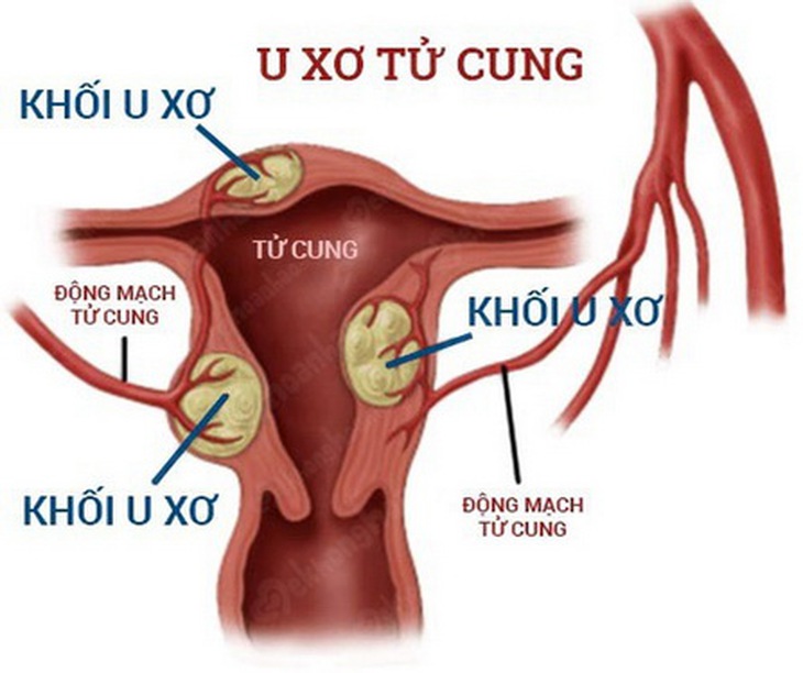 U xơ tử cung ảnh hưởng tới khả năng đậu thai và quá trình mang thai.