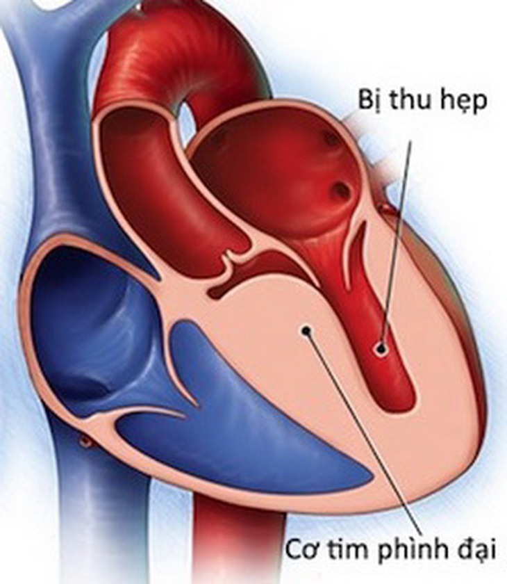 Uống nhiều rượu có thể dẫn đến viêm cơ tim.