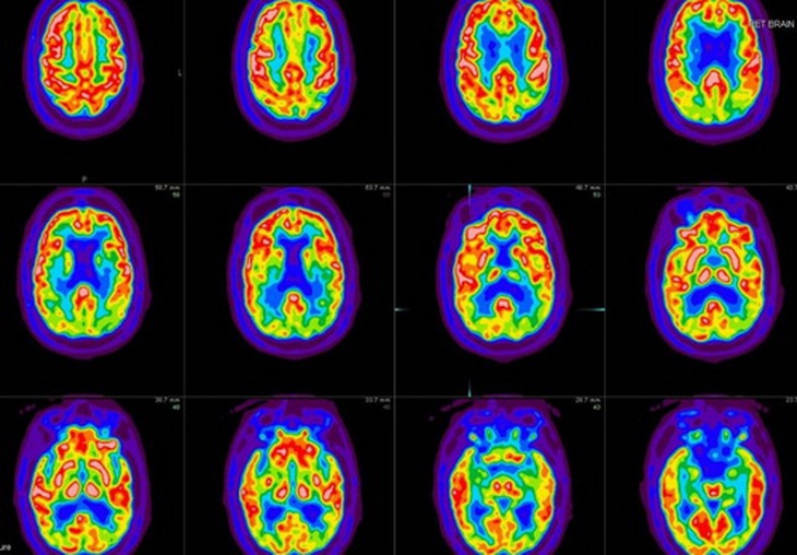 Hình ảnh CT scan não người bệnh LBD.