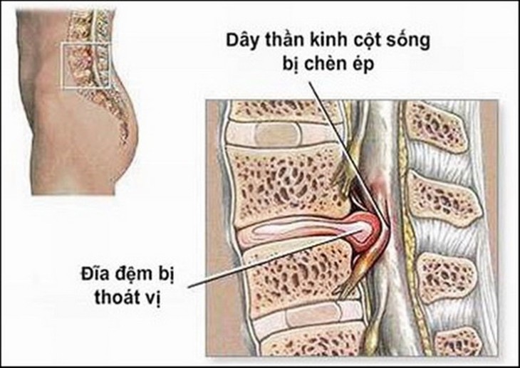 Hình ảnh thoát vị đĩa đệm.