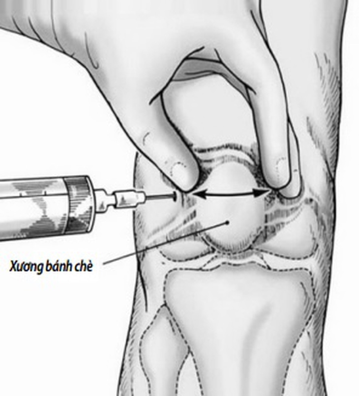 Tiêm vào khớp gối không đúng kỹ thuật, không đảm bảo vô khuẩn, bệnh nhân có nguy cơ nhiễm trùng rất nguy hiểm.