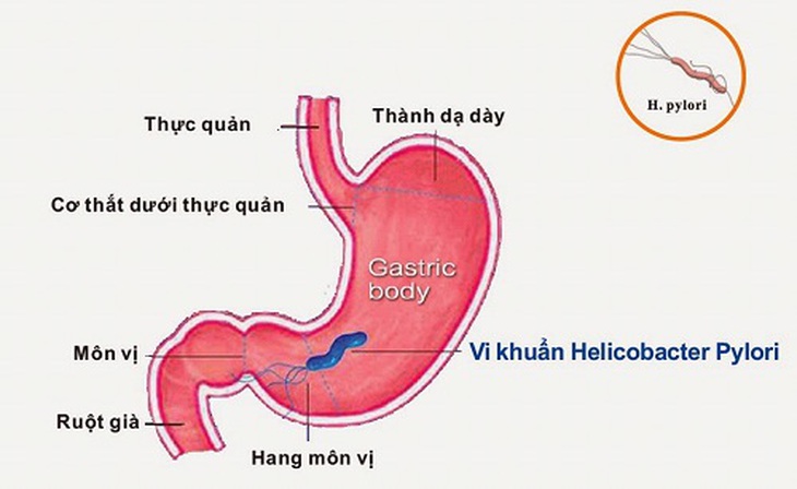 Nhiễm vi khuẩn HP là một trong những nguyên nhân cơ bản mắc viêm dạ dày.