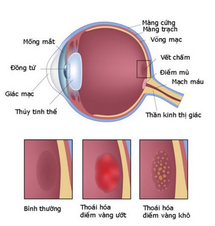 Thoái hóa điểm vàng là nguyên nhân hàng đầu gây giảm thị lực và mù lòa.