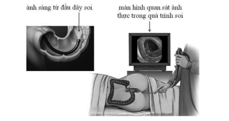 Hình ảnh mô tả nội soi đại tràng.