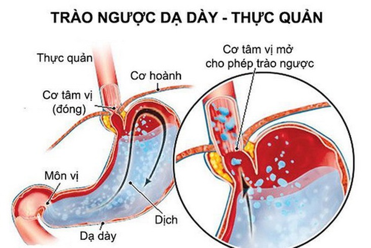 Hình ảnh trào ngược dạ dày - thực quản.