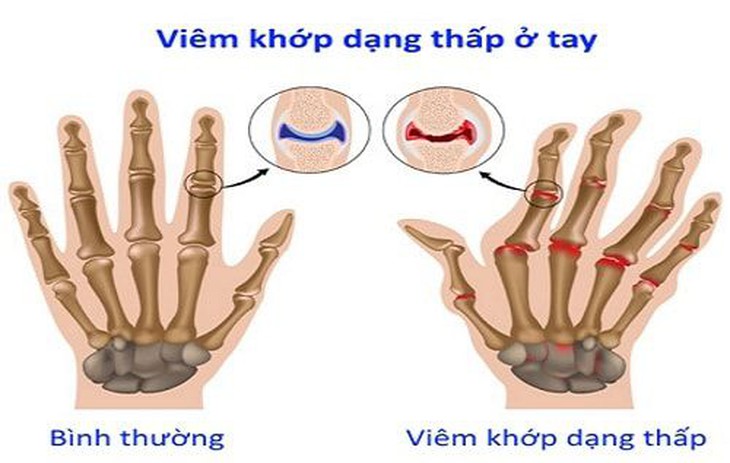 Biến dạng khớp bàn tay do viêm khớp dạng thấp.