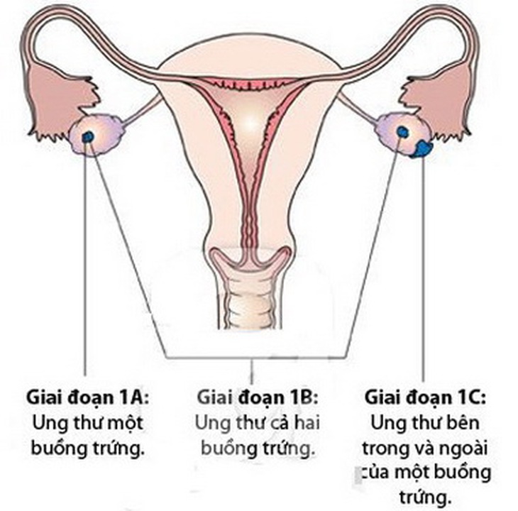 Các giai đoạn phát triển ung thư buồng trứng.