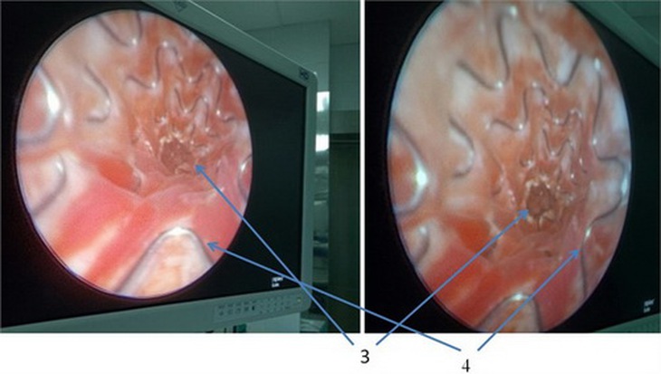 3: Chỗ hẹp của niệu quản; 4: stent trong lòng niệu quản.