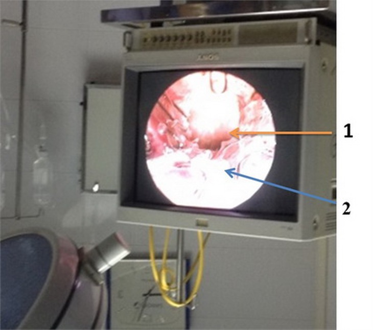 1: Chỗ hẹp niệu đạo; 2: stent trong niệu đạo.