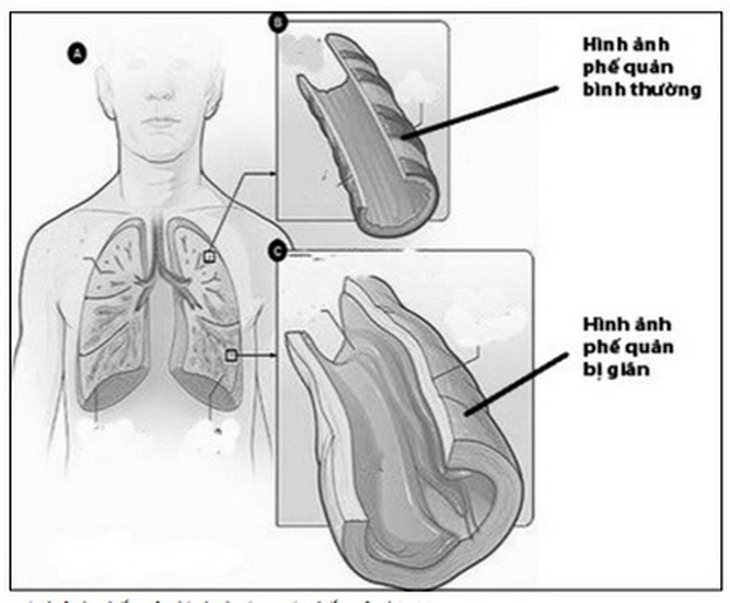Hình ảnh phế quản bình thường và phế quản bị giãn.