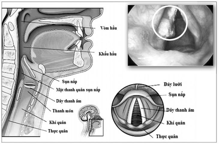 Khàn tiếng là một biểu hiện của nhiều bệnh lý liên quan đến đường hô hấp, trong đó có ung thư thanh quản.
