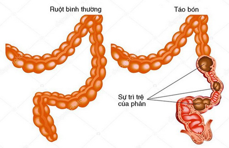 Lạm dụng thuốc điều chỉnh nhu động ruột có thể gây táo bón.