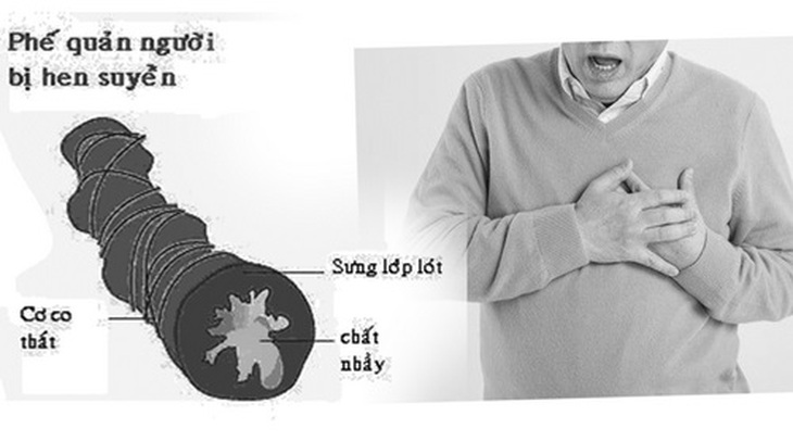 Bệnh nhân hen mạn tính tăng nguy cơ mắc bệnh tim.