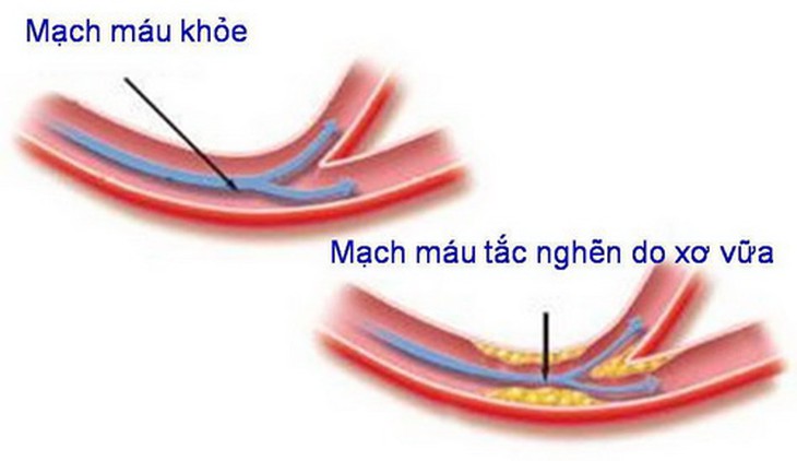 Nấm linh chi có tác dụng ngừa xơ cứng mạch.