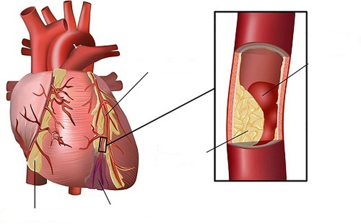 Triglyceride máu cao làm xơ vữa động mạch gây nguy cơ bệnh mạch vành và gan nhiễm mỡ.
