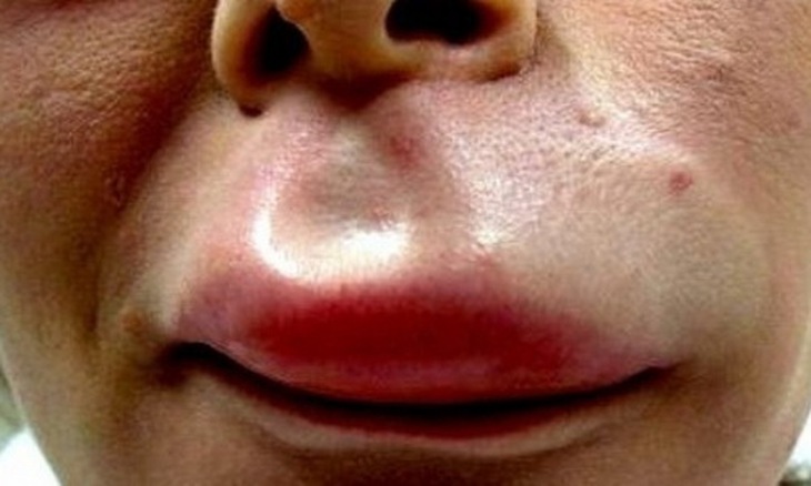 Sưng môi do côn trùng cắn, đốt.