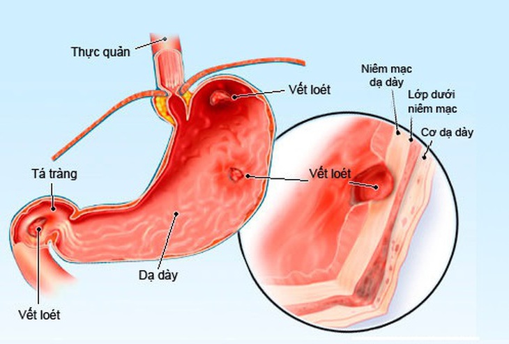Thuốc chống co thắt cơ trơn được sử dụng trong viêm dạ dày ruột.