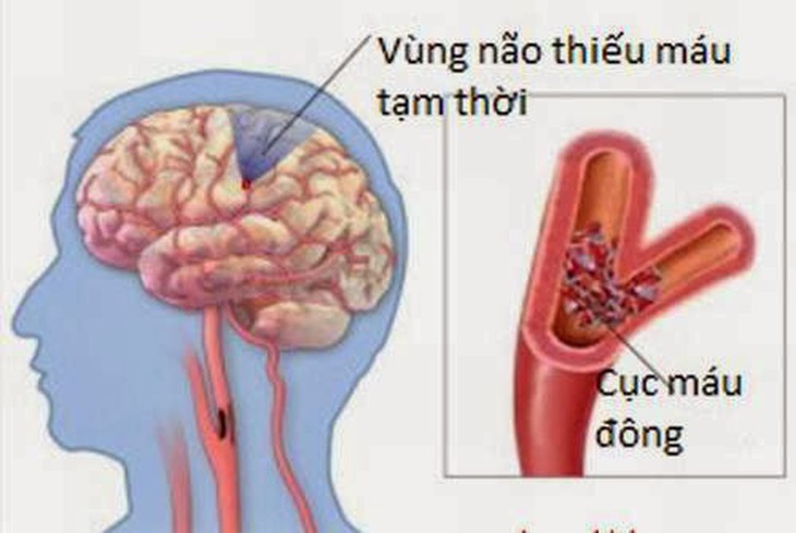 Cục máu đông làm nghẽn mạch là nguyên nhân chính gây tai biến mạch máu não.