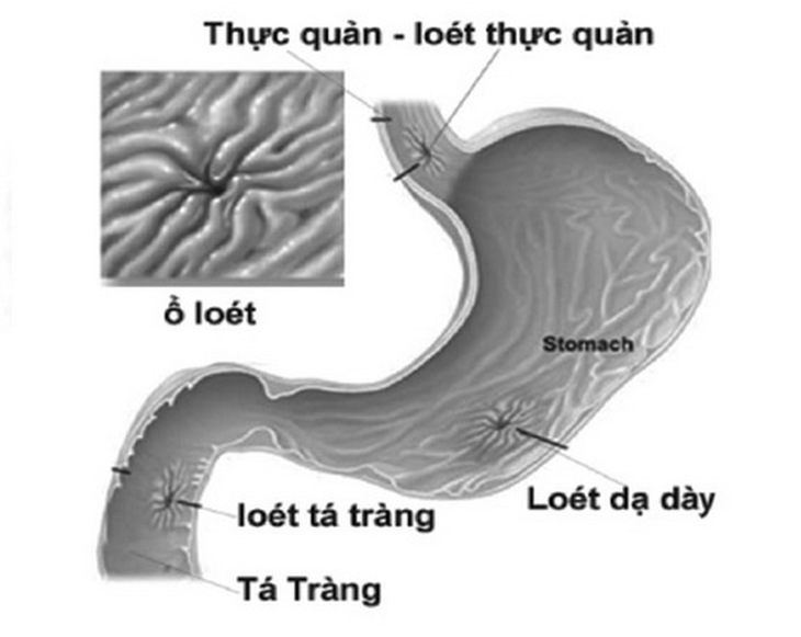 Các thuốc chống viêm không steroid dễ gây hại cơ quan tiêu hóa.
