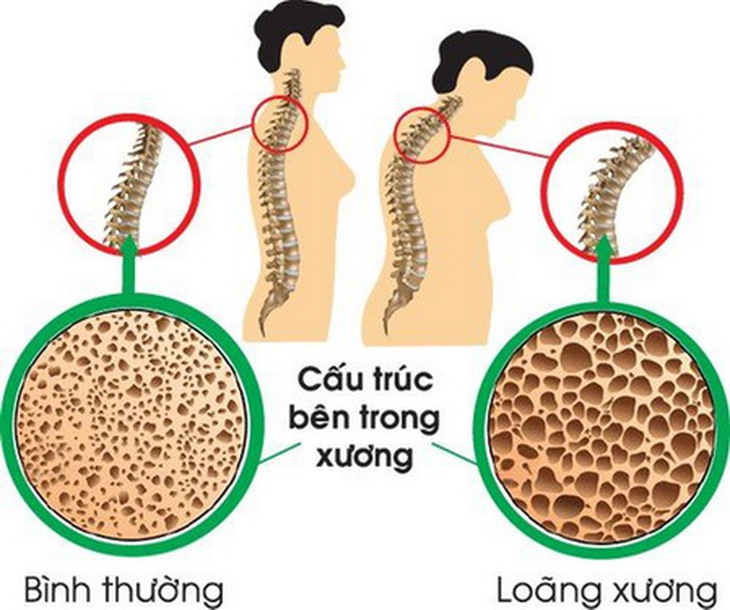 Canxi là thuốc giúp tạo xương nhưng lạm dụng có thể gây hại cho sức khỏe.
