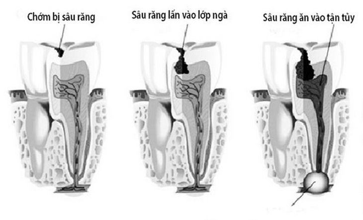 Cần khám răng định kỳ để phát hiện sớm bệnh lý răng miệng.