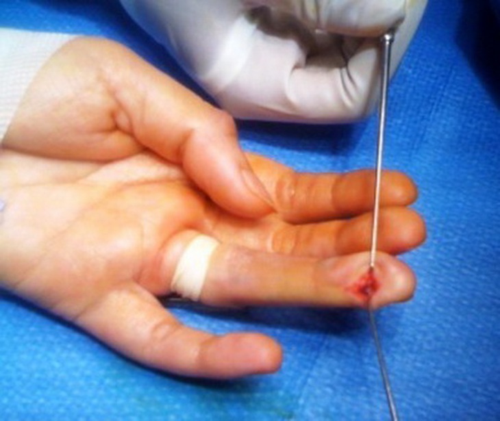 Hình ảnh u cuộn mạch búp ngón tay.