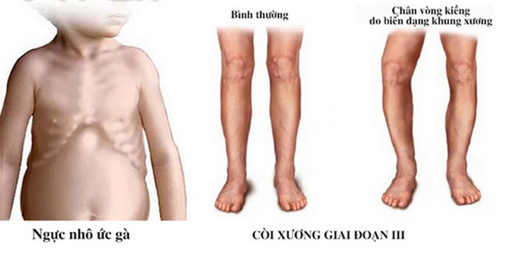 Trẻ bị còi xương do thiếu vitamin D.