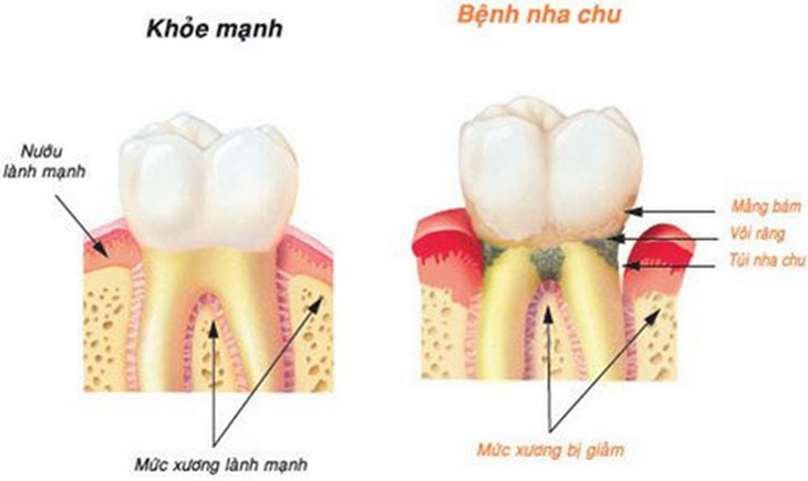Viêm nha chu là bệnh lý răng miệng thường gặp hiện nay.