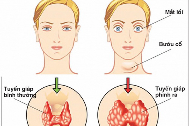 Bướu cổ (Basedow) hay gặp ở người trưởng thành, đặc biệt là nữ.