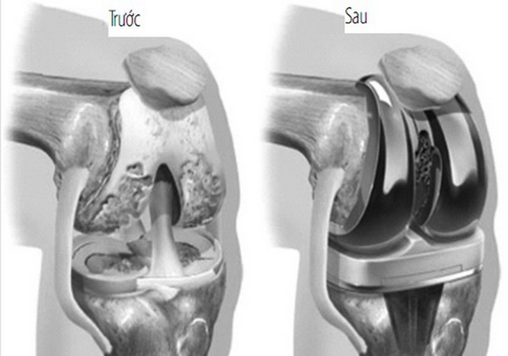 Các vật liệu thay thế chức năng xương khớp sẽ được phủ nano để tăng tính tương thích.