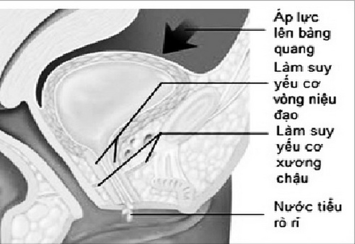 Rối loạn tiểu tiện do rất nhiều nguyên nhân, cần đi khám để có hướng điều trị đúng.