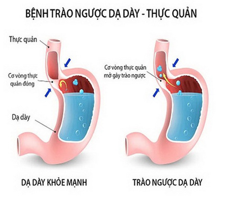 Hình ảnh trào ngược dạ đày.