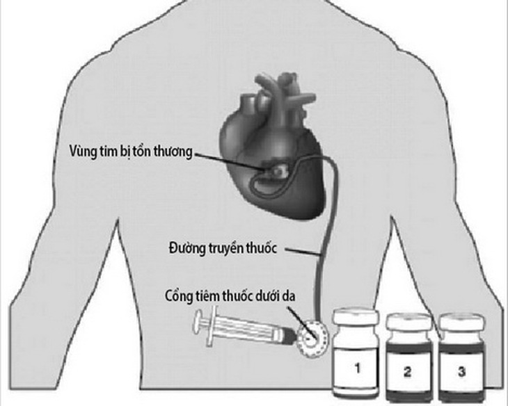 Mô phỏng thiết bị đưa thuốc thẳng đến tim để phục hồi vùng tim bị tổn thương sau nhồi máu.