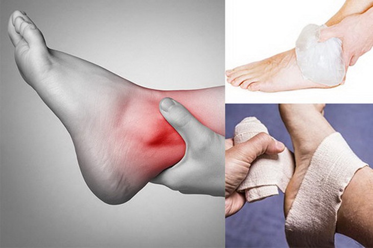 Bị bong gân cần được khám và điều trị đúng cách tránh gây biến chứng nguy hiểm.