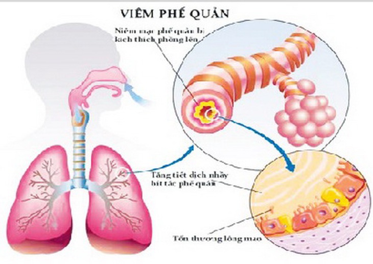 Viêm phế quản Đông y xếp vào ôn bệnh, do ôn tà ở phần khí, nhiệt tích ở phế.