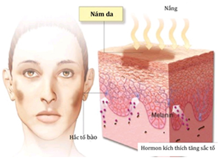 Quá trình hình thành nám, sạm da.