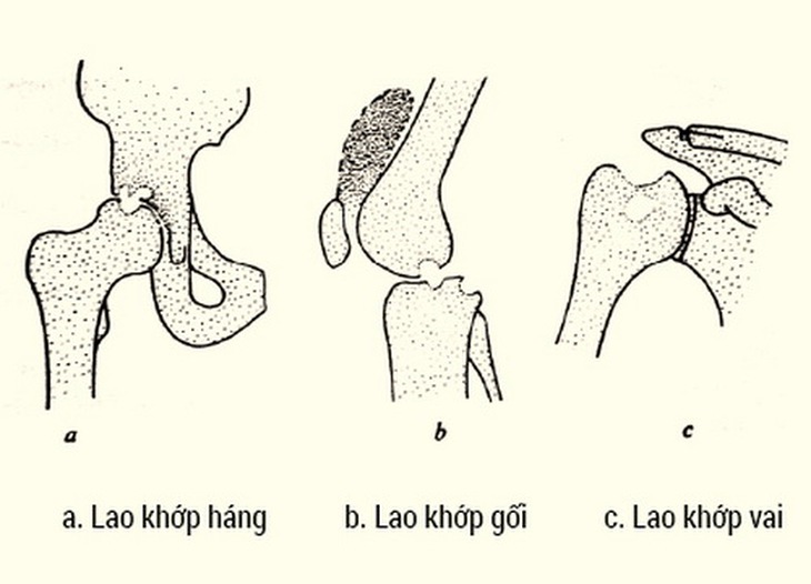 Một số thể lao xương khớp.