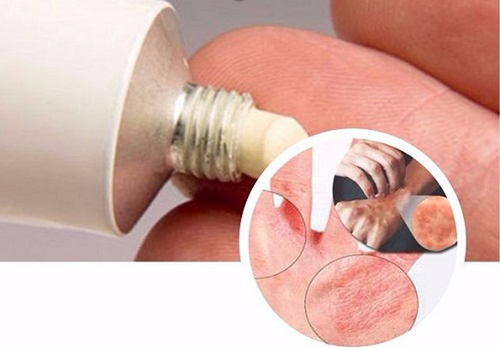 Bôi thuốc chữa ghẻ, bệnh lý thường gặp sau mưa, lũ.