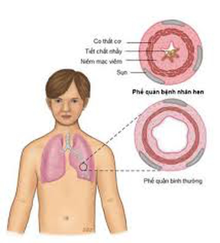 Nhựa sung trị mụn, chữa nhức đầu.