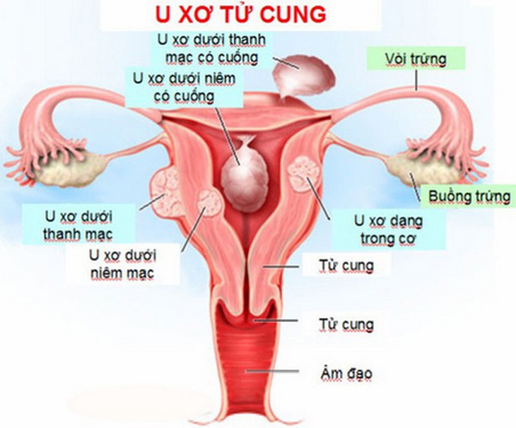 Các khối u xơ tử cung là nguyên nhân gây rong kinh.