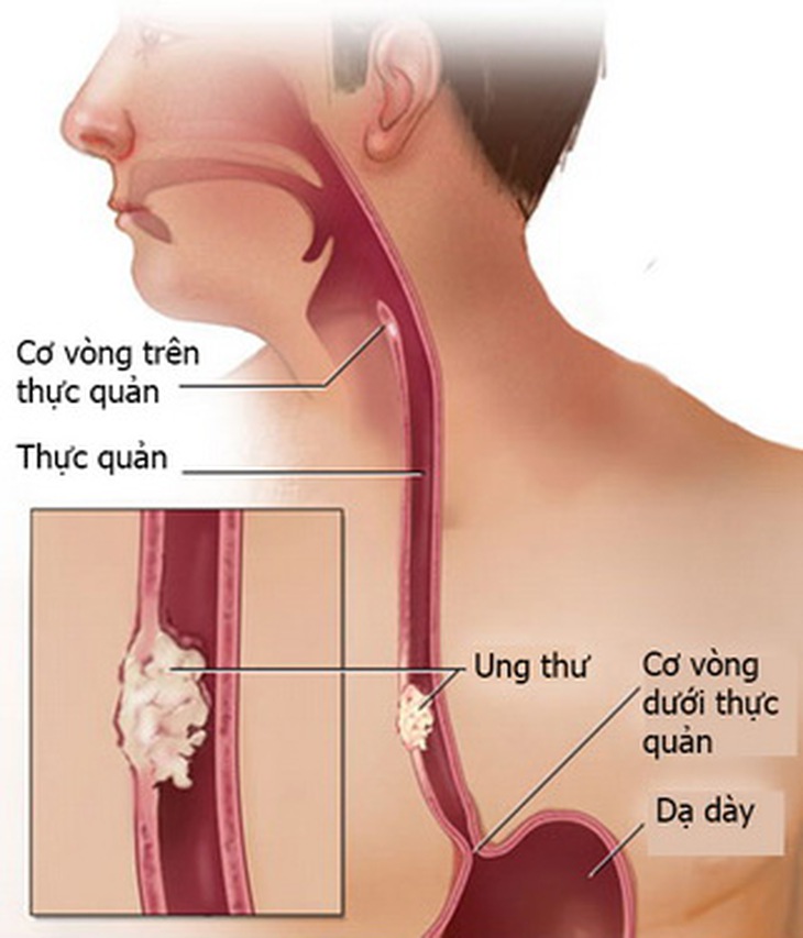Loét thực quản lâu dần dễ dẫn đến ung thư thực quản.