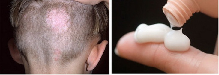 Cần dùng thuốc corticosteroid xịt theo chỉ dẫn của bác sĩ.