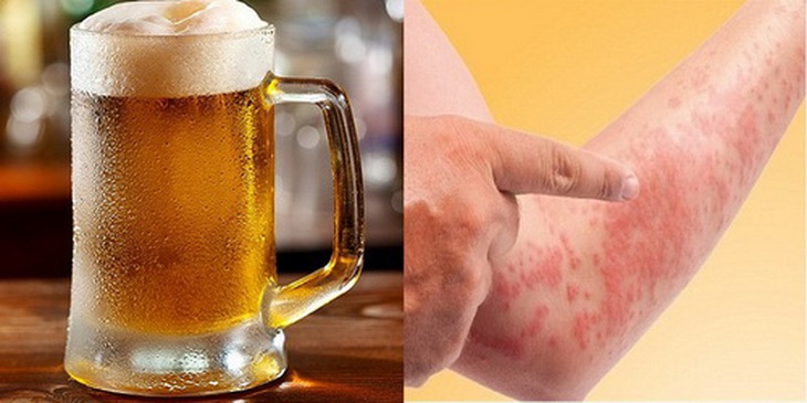 Lạm dụng rượu, bia dễ gây dị ứng.