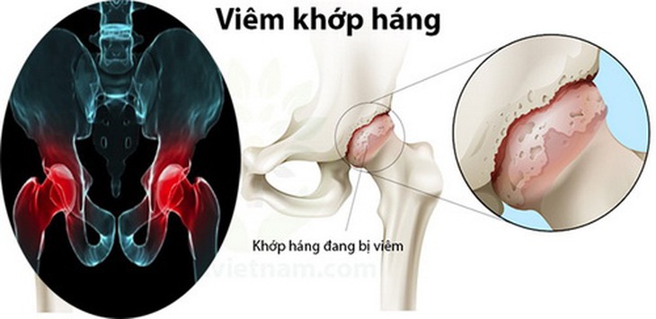 Viêm khớp háng thường bị bỏ qua.