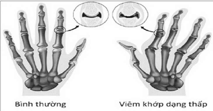 Hình ảnh viêm khớp dạng thấp.