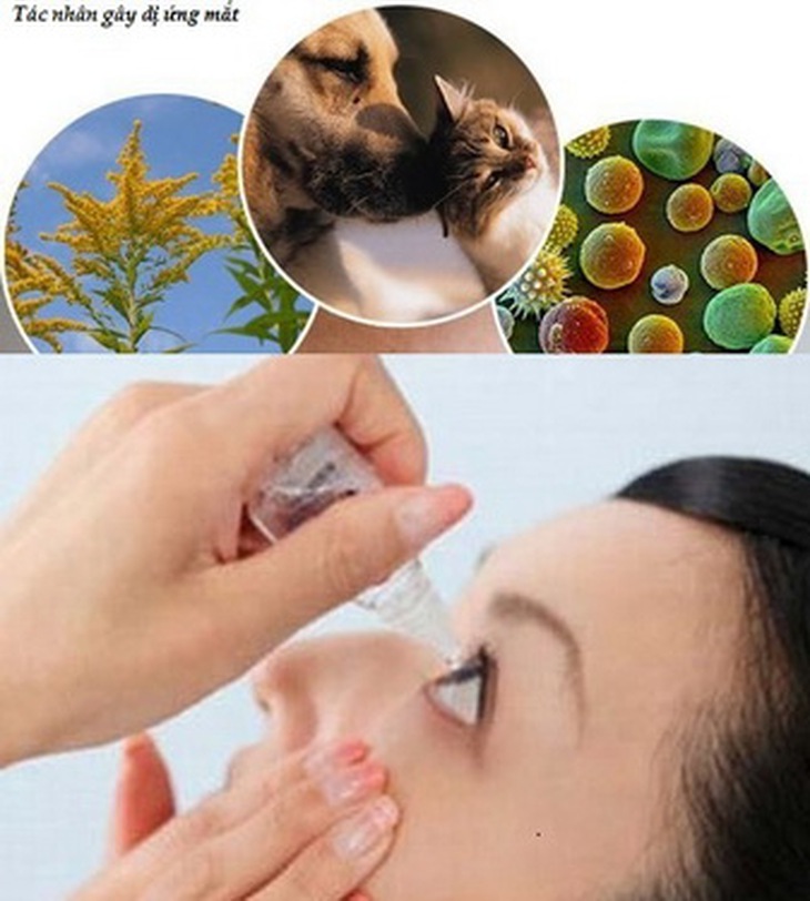 Dùng thuốc chữa dị ứng mắt phải do bác sĩ chỉ định.