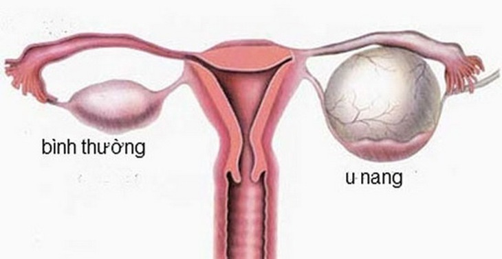 Buồng trứng bình thường (trái) và buồng trứng bị u nang (phải).