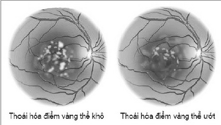 Hình ảnh thoái hóa điểm vàng.